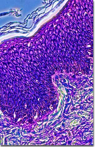 keloid histology